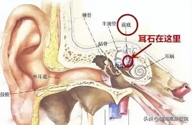 耳石症手法复位图解 位置性眩晕，耳石症手法复位图解 治疗